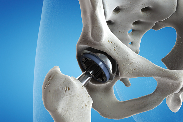 hip replacement lawsuit